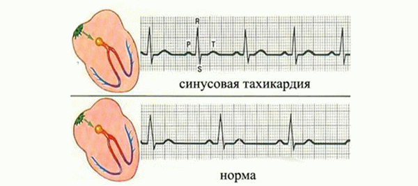 Венозная тахикардия