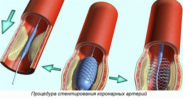 Процесс коронарного стентирования